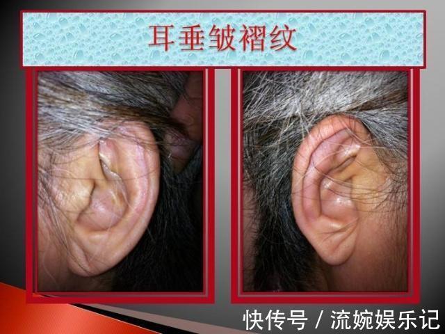 心脑血管疾病|经医院查出血脂较高后，注意少吃3类食物，多做4件事，血管不拥堵