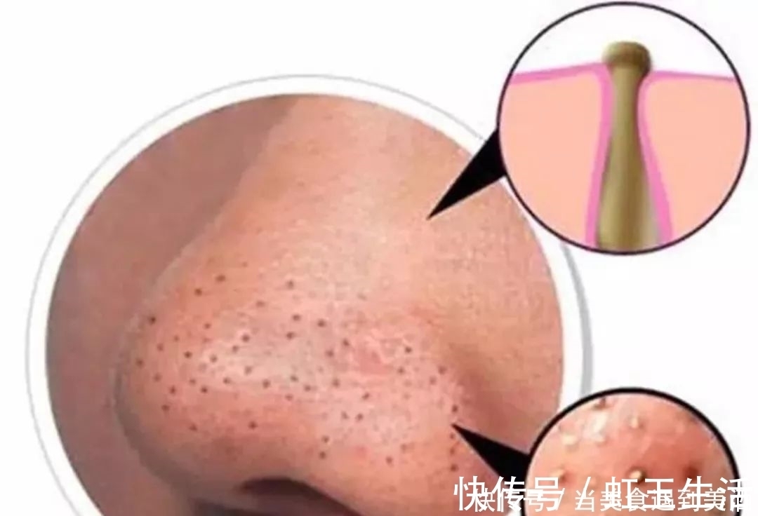 草莓鼻|女生几个坏习惯，会使你的鼻子越来越丑！草莓鼻都是轻的