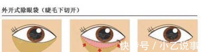 杨主任 杨甄宇眼部整形之祛眼袋手术!