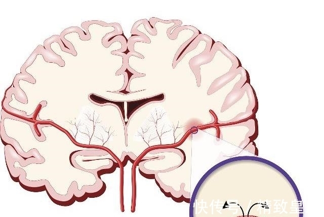 谣言|高血压可以根治?关于高血压的七种常见谣言,今天就给大家说清楚