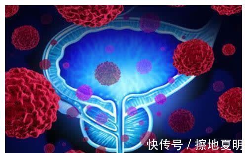 患者|患上这三种癌,算不幸中的万幸:合理治疗,或能健康