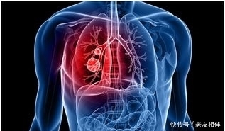 为何肺癌一经查出总是晚期?门诊专家:多数人忽略了4种前兆