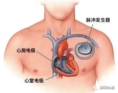 心房|【健哥说心脏】这时候该植入起搏器了——起搏器的应用