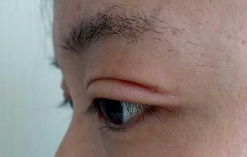 组织|双眼皮术后出现肉条的不同原因和修复方法