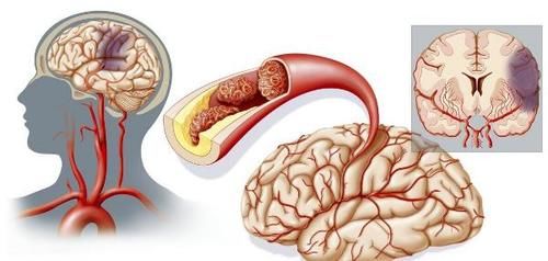 他汀类药物|17.7%的脑梗死患者会复发,怎么办?做到三个坚持是关键