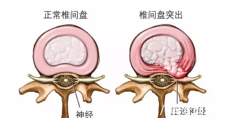 腰痛史|什么是腰椎间盘突出症?腰椎间盘突出症有哪些症状?