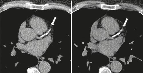 颈动脉内膜|“血管老化”的五大常见征象，您有吗？及时干预，哪些药物可选？