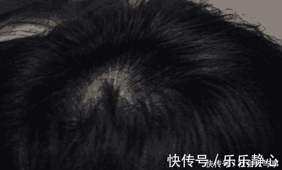 脱发类|医生提醒妈妈们给孩子扎辫子时不可用力过猛，会患上脱发类疾病！