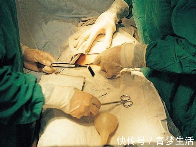 孕妇|同样是被“划一刀”,侧切和剖腹产这7个方面区别大,你很难想到