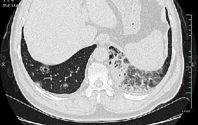 肿瘤|大伯肺里刮“台风”？竟然已是癌症晚期