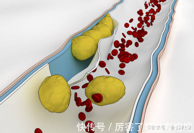 高血脂|高血脂“克星”大公开!坚持做三件事,血管干净,血脂乖乖听话!