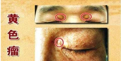 维生素c|高血脂多是“吃”出来的医生警告3种食物不戒掉,血脂不会降