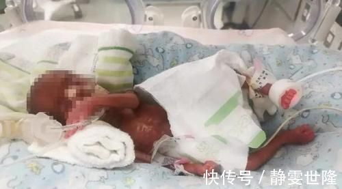 早产儿|不足26周降生,出生体重仅1斤,超早产儿果果如何“闯关成功”?