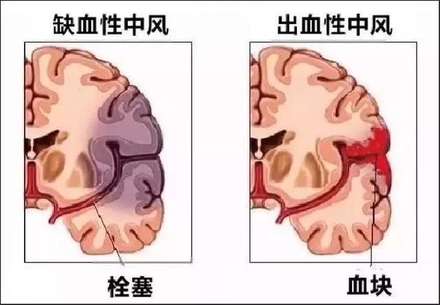 不良生活习惯|脑卒中年轻化 预防需摒弃不良生活习惯