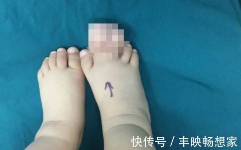 宝宝|得了这病,半岁宝宝脚趾比香蕉还粗!不注意还会复发…