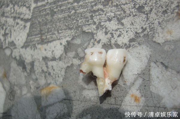 干细胞|孩子退掉的乳牙,父母不要乱扔,关键时刻能救孩子一命!