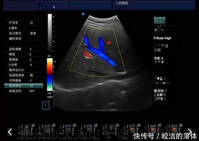 液体|做B超前涂的那层黏黏的、凉凉的液体是什么？做完要马上洗掉吗？
