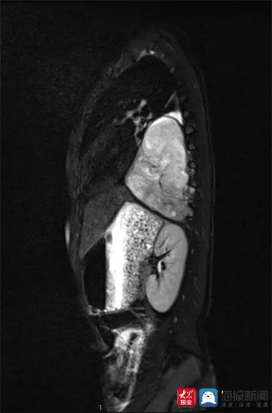 先天性|四岁男孩患肿瘤 泰安市中心医院儿外科新设备助力精准切除