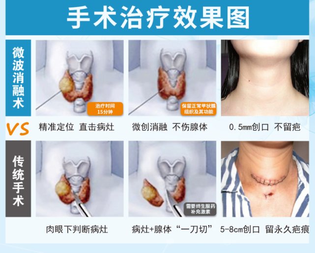 结节|微波消融甲状腺结节安全吗？你关心的问题都在这里了！