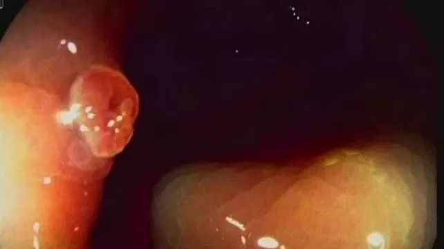 艾灸|大家好!我叫“息肉”,癌症的近亲!我最怕无情又温柔的手术刀艾灸