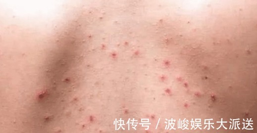 泥垢|螨虫堵塞背后毛孔时，会出现4个明显特征！来学3招除螨