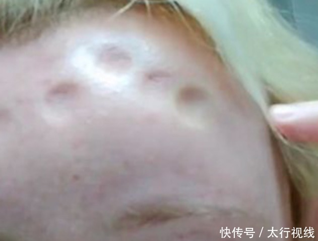 过敏反应|晒了一会日光浴,英国女子突发过敏反应,脸肿成原来两倍大