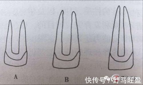 牙根|牙医姐姐讲故事︱断牙如何修补？别让意外“折”了童年的欢乐