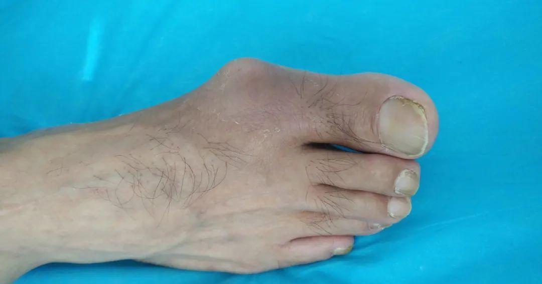 海鲜|“高嘌呤”食物清单已公布，猪肉排不上号，看完榜首，趁早管住嘴