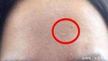 三种现象证明你脸上长了螨虫，还在用醋洗脸吗，难怪没效果