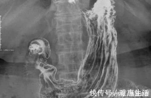 造影|肠胃不健康的人,不想做胃肠镜还有啥办法,或还可以用此检查方法