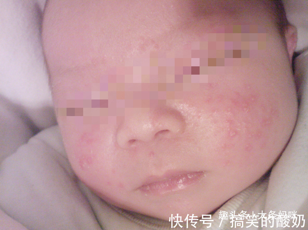 婴幼儿|十个妈妈九个愁,恼人的婴幼儿湿疹,到底应该怎么“破”