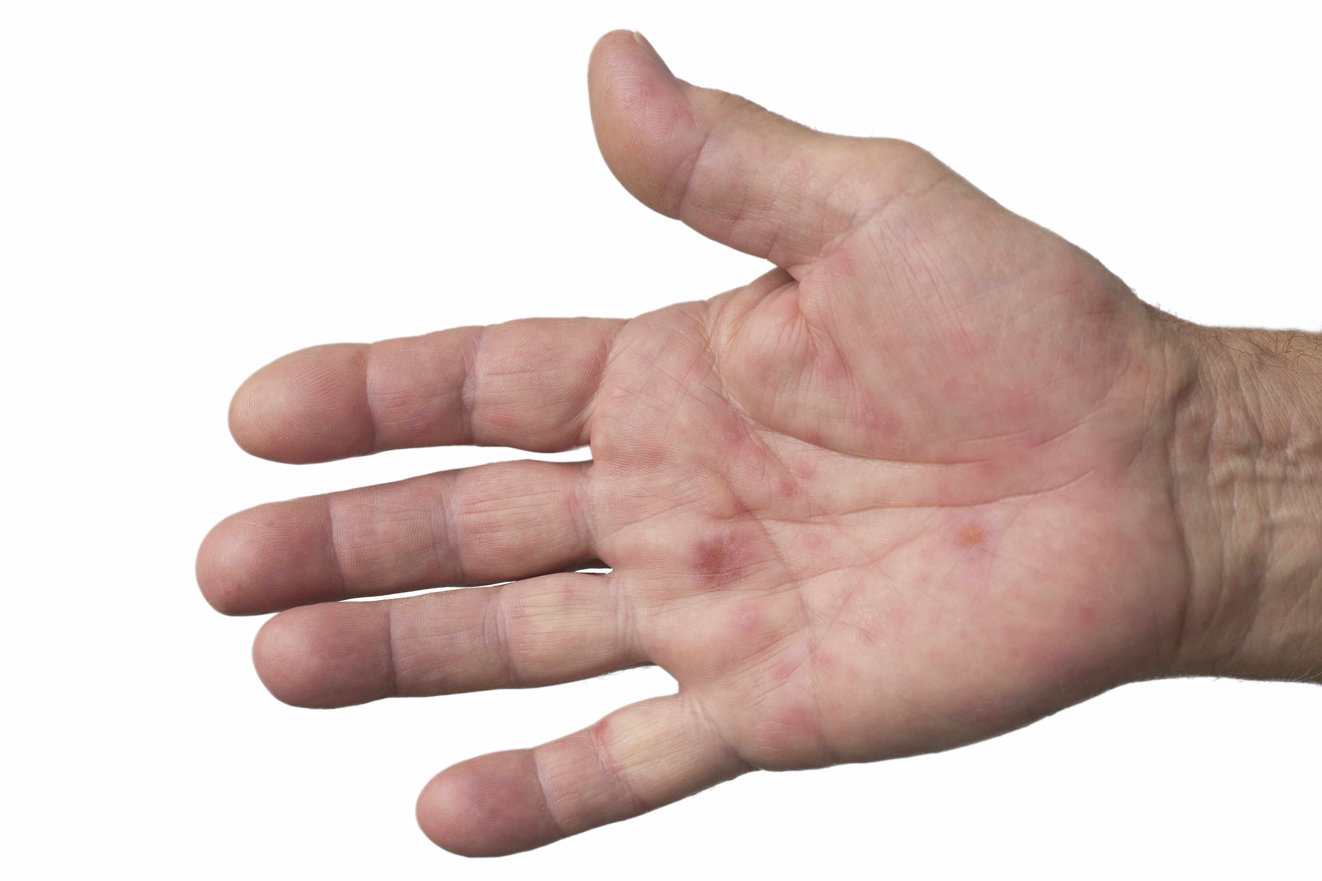注意，手掌上这两块发红的要警惕，可能是肝硬化的标志|肝掌|肝脏|肝硬化_新浪新闻
