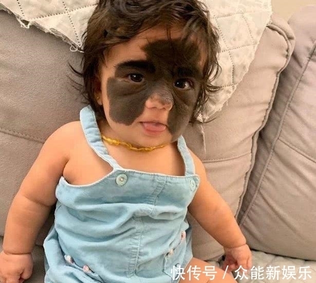 外科医生|真人版“蝙蝠侠”,美国一婴儿患罕见黑色素痣,形状酷似蝴蝶翅膀