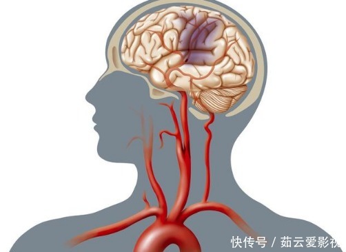 颈动脉狭窄|颈动脉斑块如何清除?医生讲的清清楚楚:不同斑块不同方法