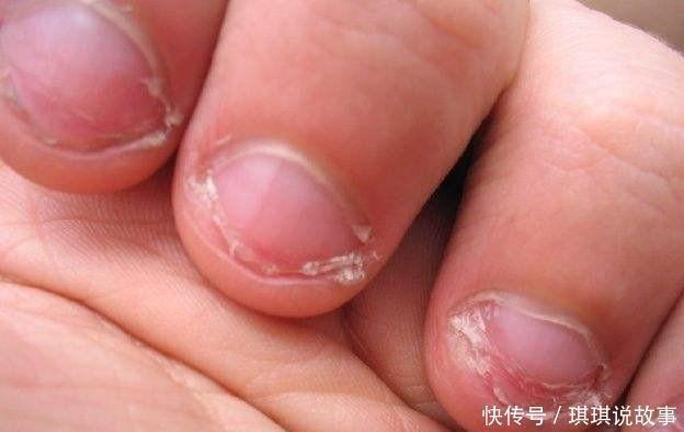 猪肝泥|提醒家长6个信号说明小孩缺锌了,不重视会影响智力发育