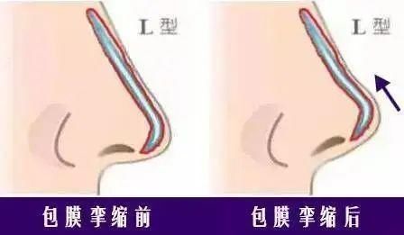 膨体|隆鼻后假体要定期更换吗?出现这些情形就该更换假体了!