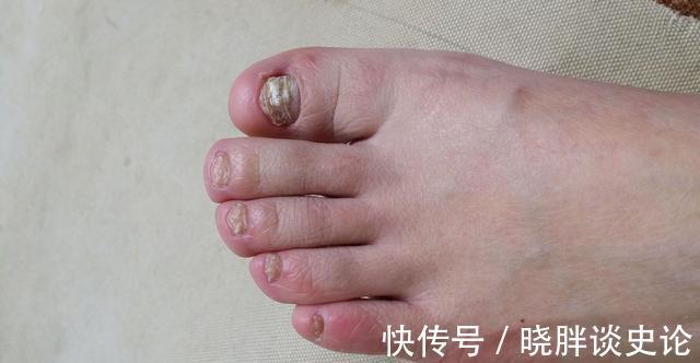 高血脂|高血脂患者，身体会有哪些表现，早了解早好