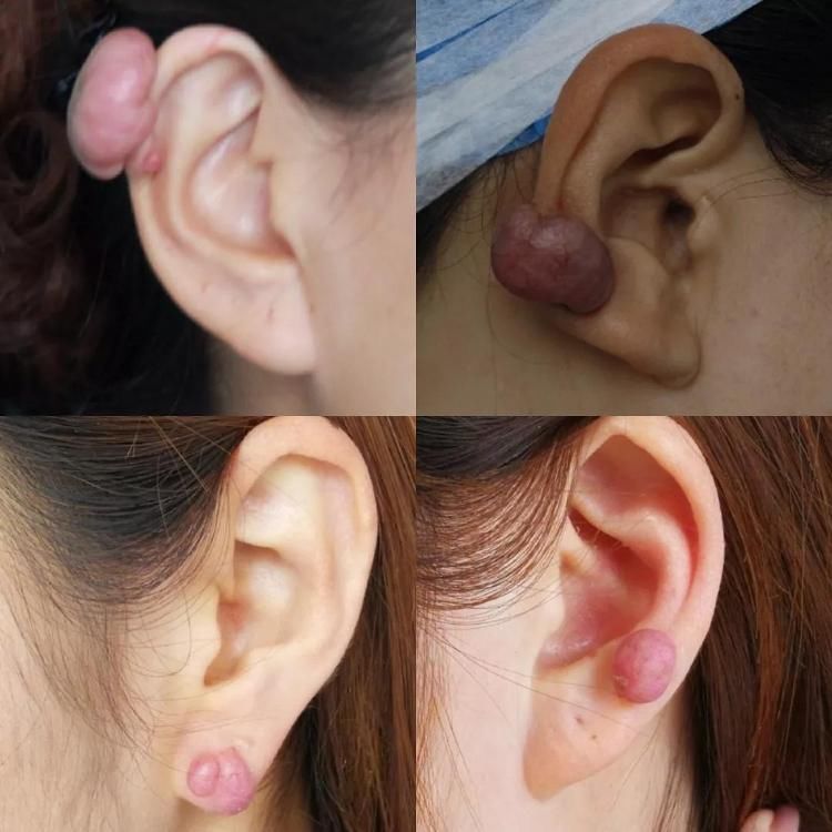 整形科|打耳洞打出的病——耳廓瘢痕疙瘩