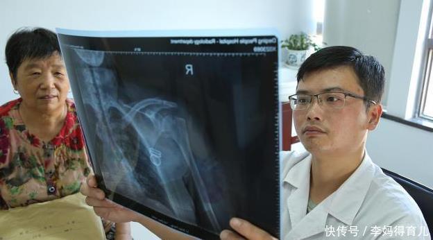 56岁女子，查出滑膜炎，医生惋惜：身体早有提示