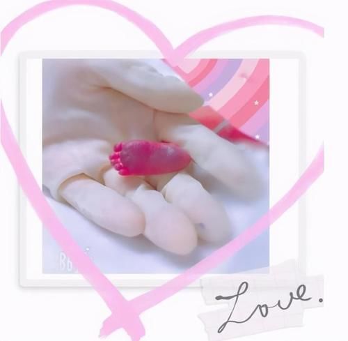 早产儿|那个出生才4百克的“巴掌公主”,半年过去怎样了?生命真是神奇