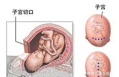 十月怀胎|生孩子剖腹产时横切和纵切哪个好好多人都选错了