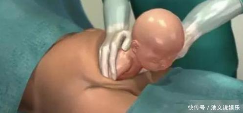 剖腹产|顺产虽好,但是剖腹产的3大好处,也是顺产没法做到的