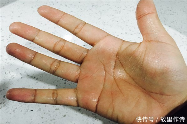 容易出汗,冬天汗也多,是怎么回事中医出汗位置反映了病根
