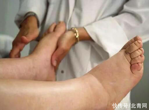 肝掌|体内有癌，手脚先知！医生提醒：手脚出现4种变化，千万不要拖