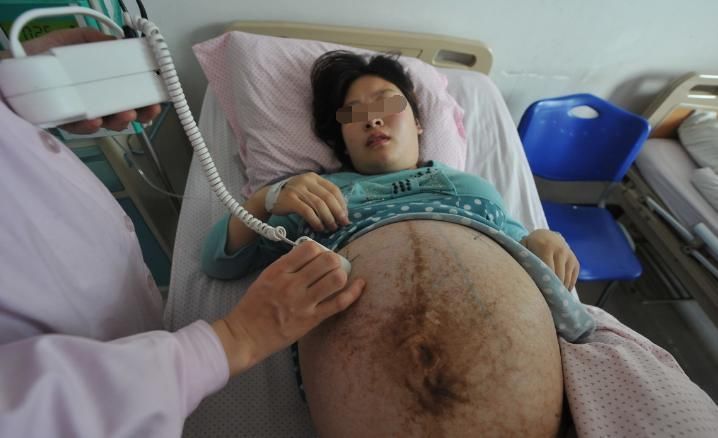 小娅|25岁女子怀孕3个月，发现连走路都变得困难，医生的话让老公忧心