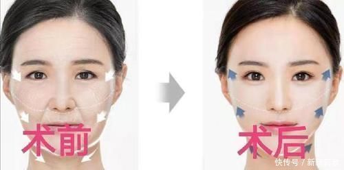 闺蜜|闺蜜小切口提升后悔做了小拉皮手术没效果别眨眼睛看我小拉皮效果~