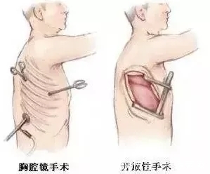 胸腔镜|刘浩医生：注意！要做肺癌手术，先了解这几点—抗癌管家