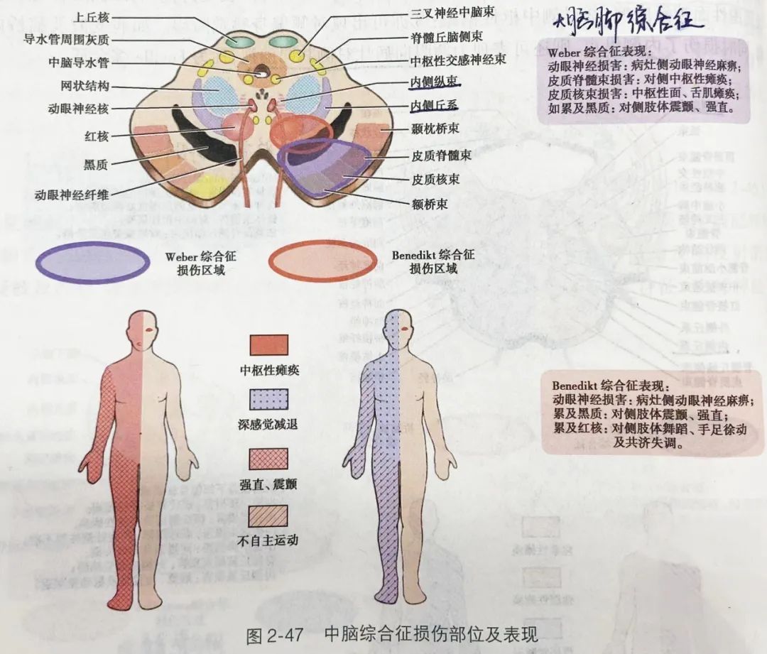 受损|脑干内 vs 脑干外病变，临床如何鉴别？