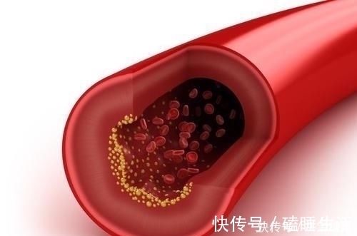 黄酮类化合物|中医院士1个食疗方，开水里放1物，血管干净、高血脂降了