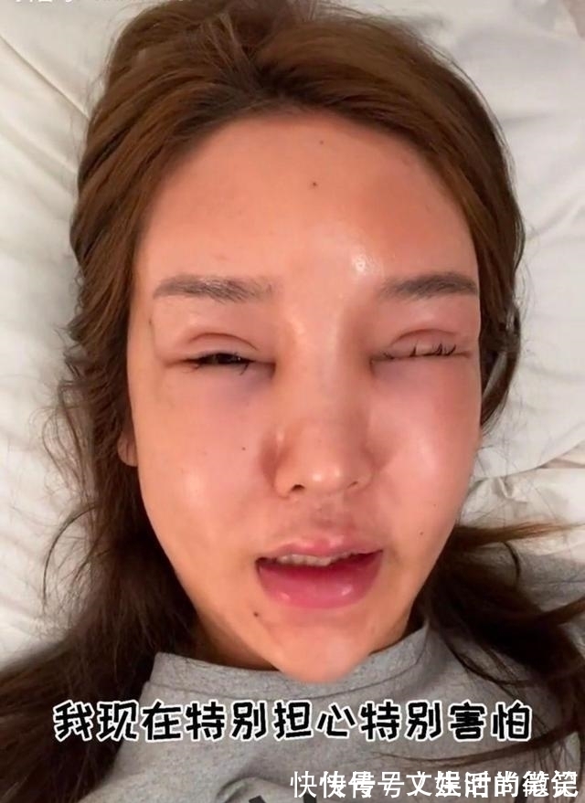 巅峰照 8年的整形手术花费了100多万，光额头就打了200多支玻尿酸